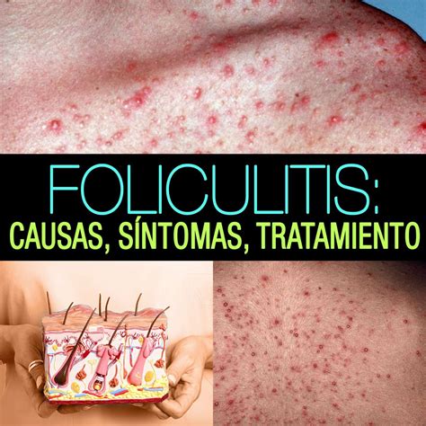 foliculitis en gluteos-1